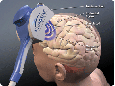 How NeuroStar TMS Therapy Works Diagram